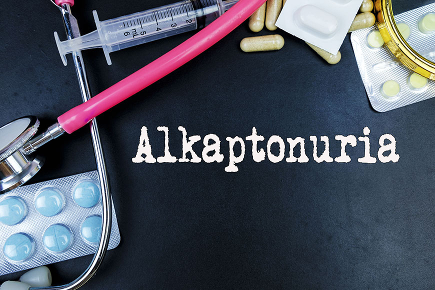 Learn about alkaptonuria – a rare metabolic disorder