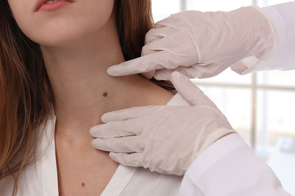 Symptoms, causes, and more about skin tags